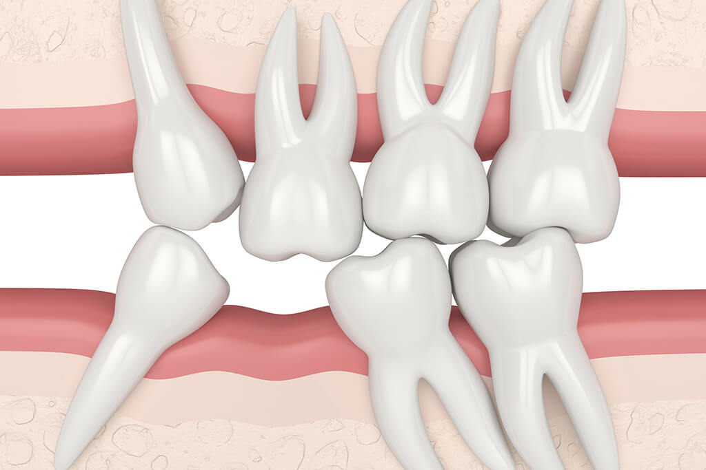 Sposoby rekonstrukcji bezzębia grafika przedstawia przemieszczanie się zębów w kierunku luki po zębie