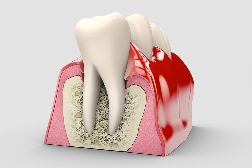 Sposoby rekonstrukcji bezzębia uzupełnienia Overdenture Grafika przedstawia korzeń zęba